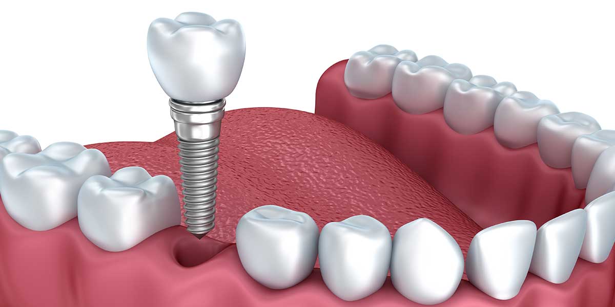 best dental implants