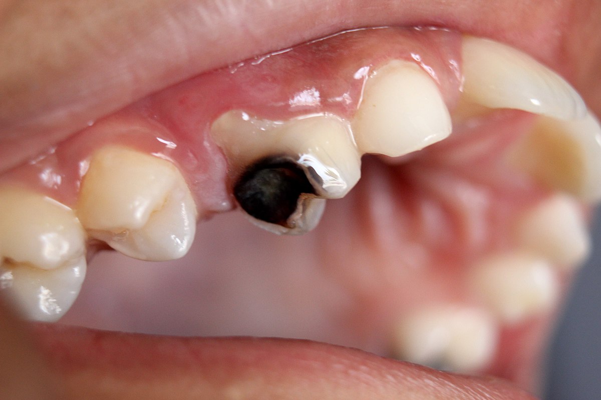 dental implants tooth decay